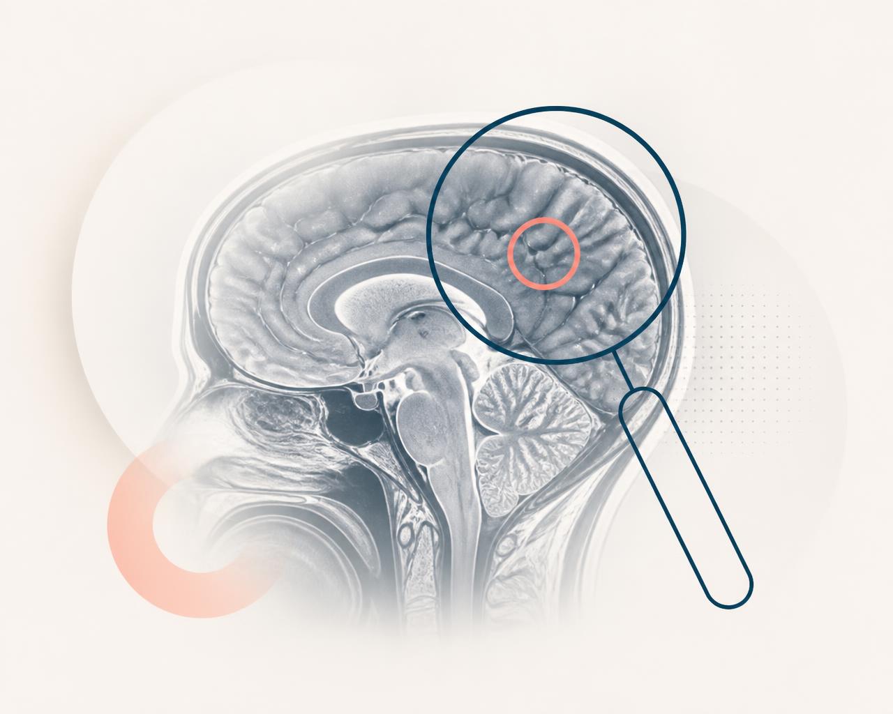 Corte de ressonância magnética de crânio com lupa destacando um achado